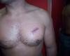 Corte en el corazon