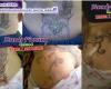 Reparando un tattoo mal hecho, caderas y nalgas (glúteos)