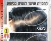   מילוי קרקפת הדמיית שיער בטיפול אחד