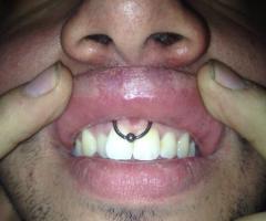 piercing BCR en el frenillo