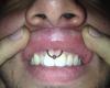 piercing BCR en el frenillo