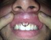frenillo superior labio
